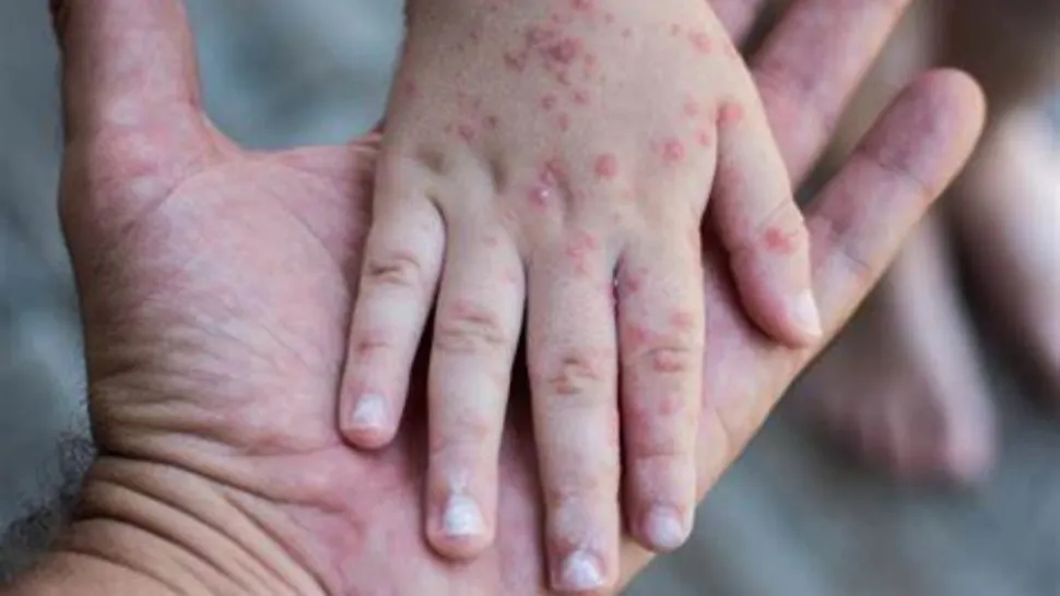 Risc uriaș de epidemie de rujeolă în România. Vaccinul ROR lipsește în mai multe județe